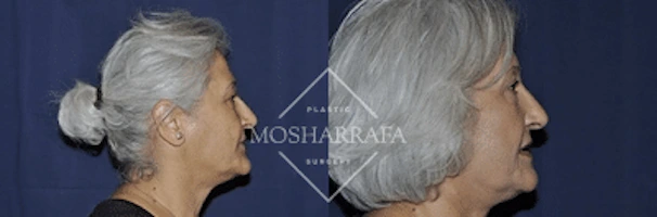 Before and after profile views of patient's face showing facial rejuvenation results