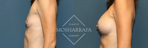 Before and after side profile comparison of breast augmentation results