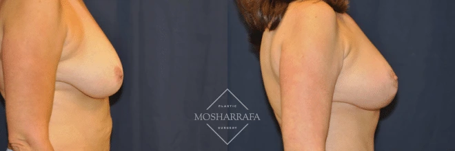 Before and after side profile showing breast augmentation results