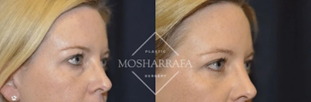 Before and after profile views showing case 184 results
