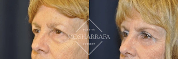 Side profile comparison showing patient's face before and after facial rejuvenation treatment