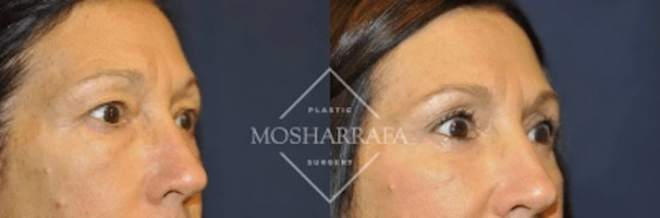 Side profile before and after comparison showing changes to patient's facial structure