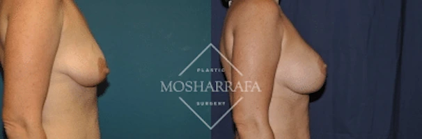 Before and after side profile showing breast augmentation results