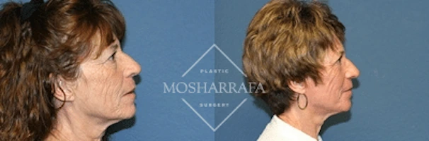 Before and after profile views of patient's face showing facial rejuvenation results