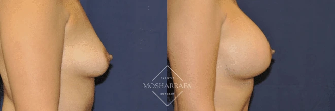 Before and after side profile comparison of breast augmentation results
