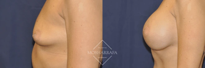 Before and after side view of breast augmentation results