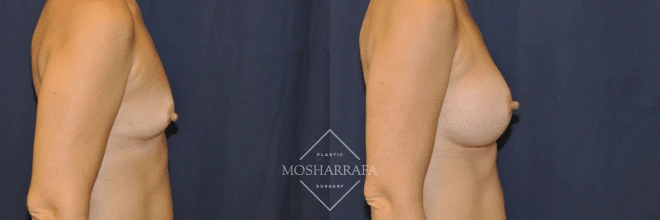 Before and after side profile comparison of breast augmentation results