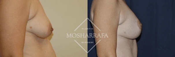 Before and after breast augmentation results, profile view comparison
