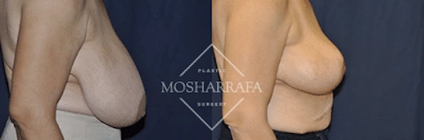 Before and after side view of breast surgery results