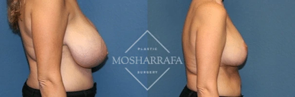 Before and after side view of breast augmentation results