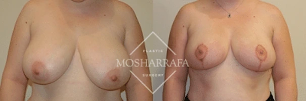 Before and after frontal view of breast augmentation results