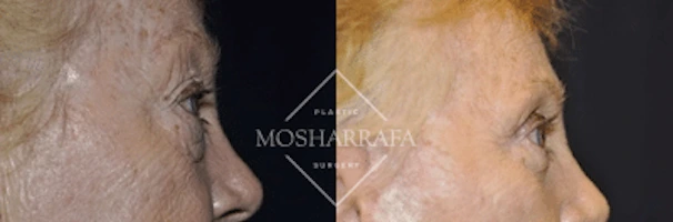 Before and after profile comparison showing lower face and neck contouring results