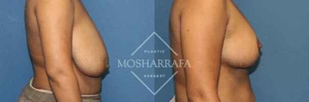Breast reduction surgery before and after, side view comparison