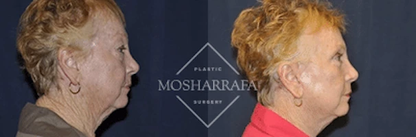 Before and after profile views of a patient's neck and chin