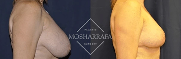 Breast lift surgery before and after, side view comparison