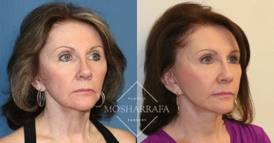Before and after profile views of a patient's face and neck