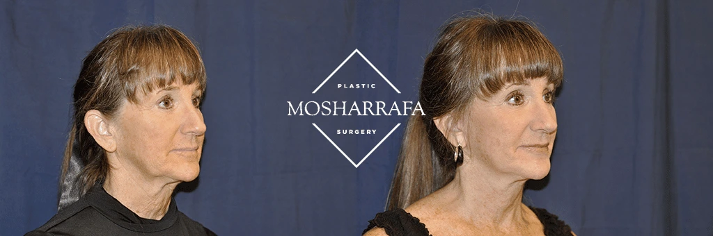 Before and after side profile of a woman showing neck and jawline definition improvement