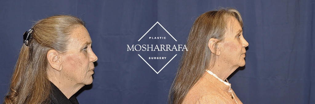 Before and after profile views of patient showing results of facial surgery at Mosharrafa Surgery