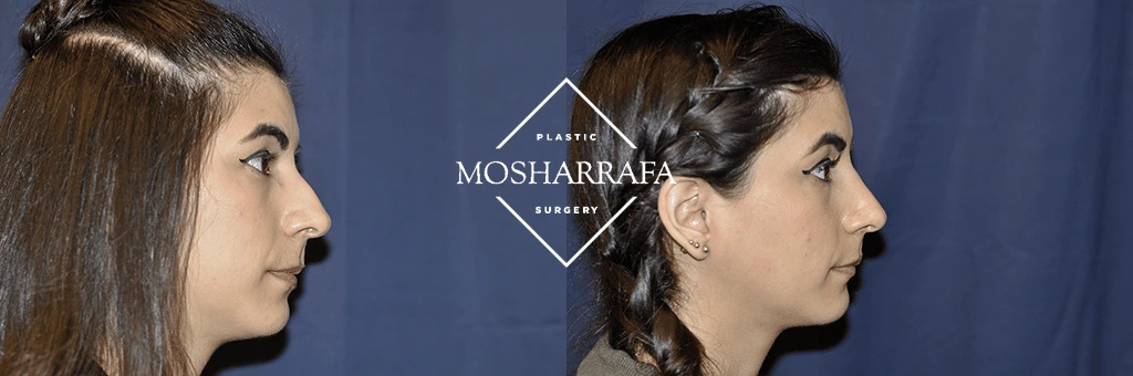Before and after profile view of female patient showing nose and chin definition
