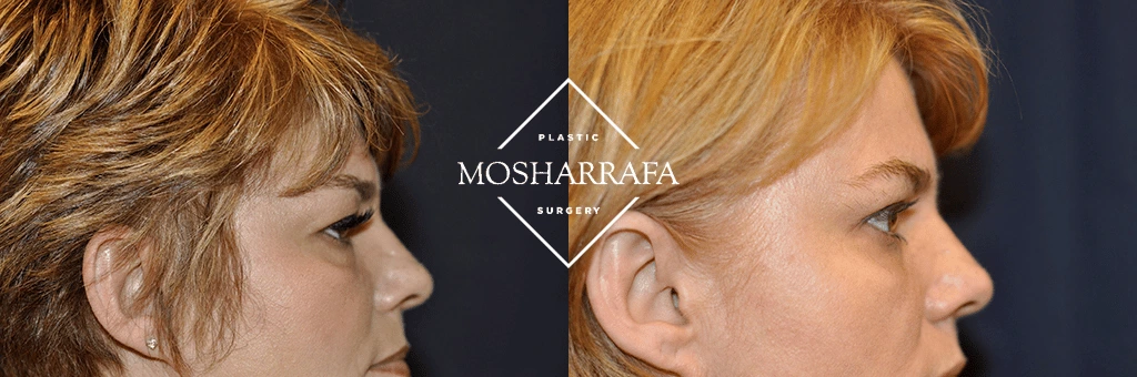 Before and after side profile view showing nose and chin refinement results