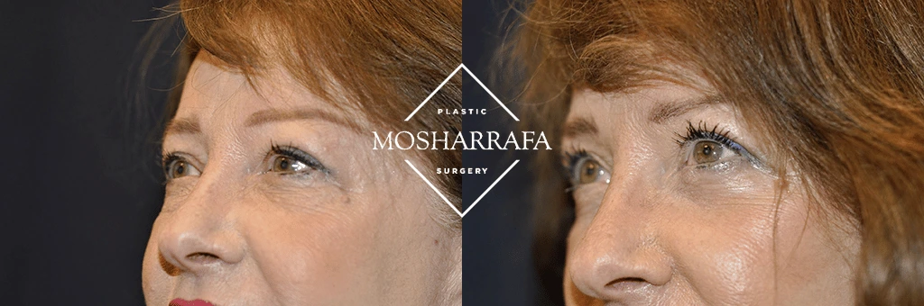 Before and after side profile view showing enhanced cheekbone and facial structure results