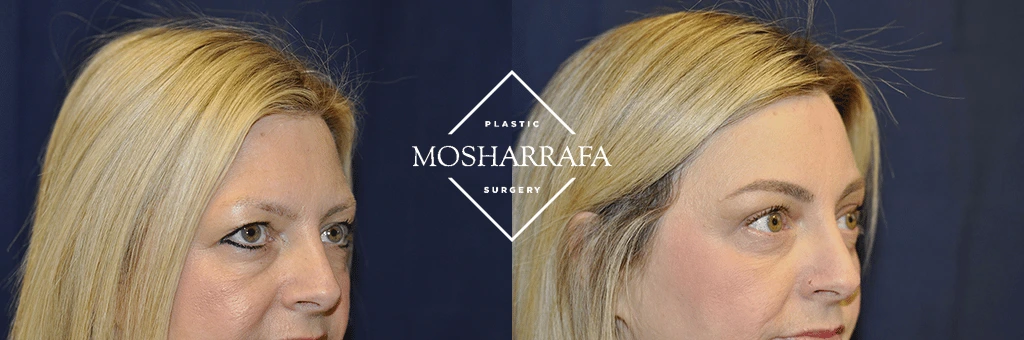 Before and after three-quarter views showing facial refinement