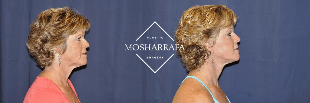 Before and after profile view of woman's face showing facial rejuvenation results