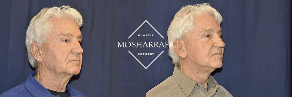 Male patient profile views before and after facelift procedure