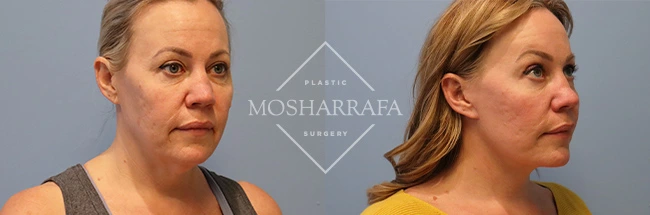 Before and after frontal and three-quarter views of facelift results showing enhanced facial volume and contours