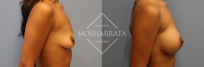 Before and after side-view comparison of breast augmentation results