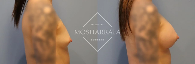 Before and after side-view comparison of breast augmentation results