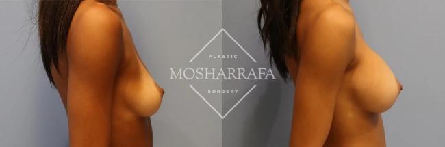 Before and after side profile comparison of breast augmentation results