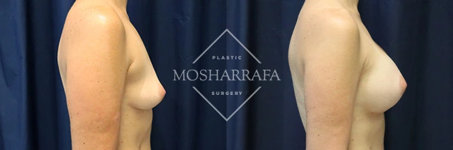 Before and after side profile comparison of breast augmentation results