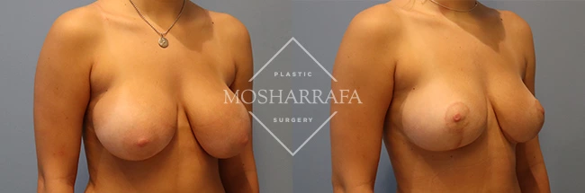 Frontal before and after surgical results showing aesthetic breast enhancement