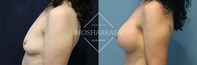 Before and after breast augmentation surgery, side profile view