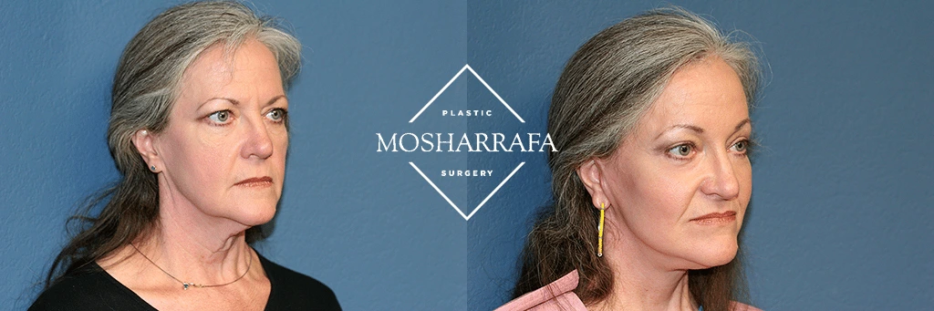 Before and after three-quarter views showing a woman's face and jawline definition