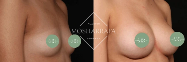 Before and after breast augmentation surgery, angle view with privacy circles