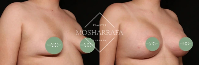 Before and after breast augmentation results, front view