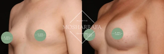Before and after breast augmentation results, front view