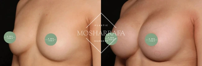 Before and after breast augmentation results, frontal view