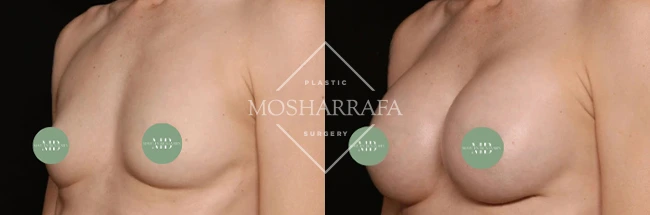 Before and after breast augmentation results, frontal view