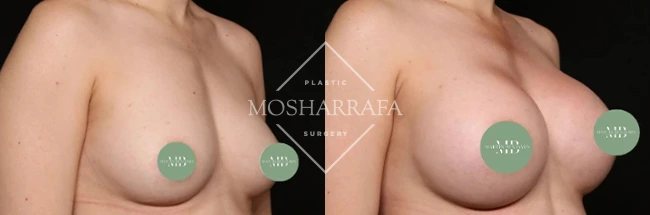 Before and after breast augmentation results, angled side view comparison
