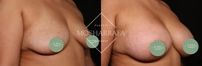 Before and after breast augmentation results, angled side view comparison