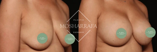Before and after side view showing breast augmentation results
