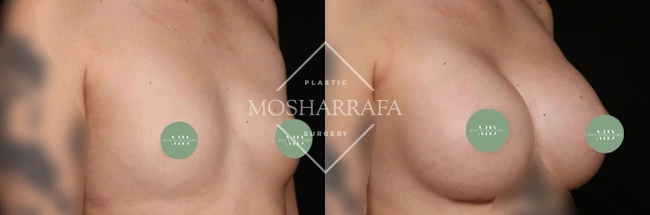 Angled side views of breast augmentation results with measurement markers