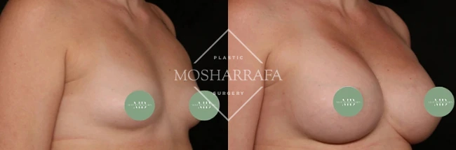 Angled side views of breast augmentation results with measurement markers