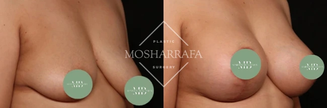 Side profile comparison of breast augmentation results, case 327
