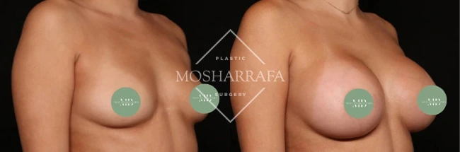 Before and after breast augmentation side view, case 328