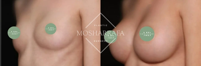 Before and after front view of breast augmentation results from different angle