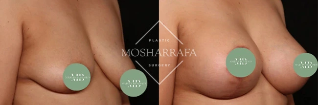 Before and after breast augmentation results showing frontal view